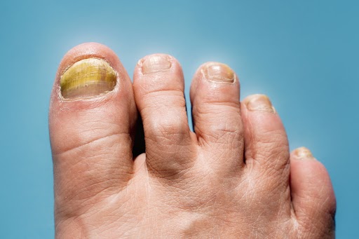 An Easy Way to Treat Toenail Fungus | The Spa MD In Rochester Hills, MI