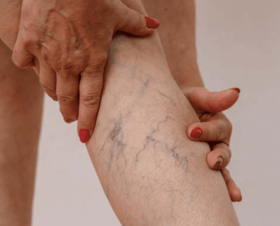 Are You Unhappy with Your Appearance Because of Your Spider Veins? | The Spa MD In Rochester Hills, MI