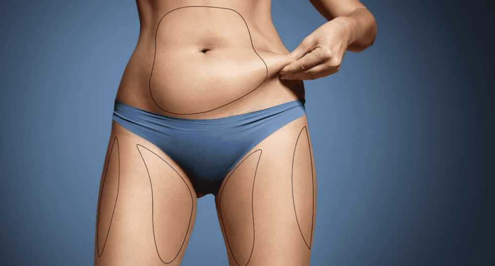 Getting Rid of Your Love Handles with CoolSculpting | The Spa MD In Rochester Hills, MI