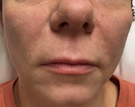 After Nasolabial Fold Filler Treatment Photo | The Spa MD In Rochester Hills, MI