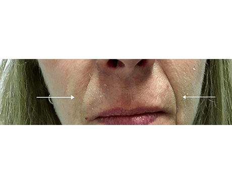 Before Nasolabial Fold Filler Treatment Photo | The Spa MD In Rochester Hills, MI