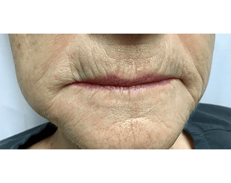 Before Pucker Line Treatment Photo | The Spa MD In Rochester Hills, MI