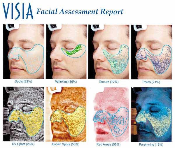 Visia Skin Analysis | The Spa MD In Rochester Hills, MI