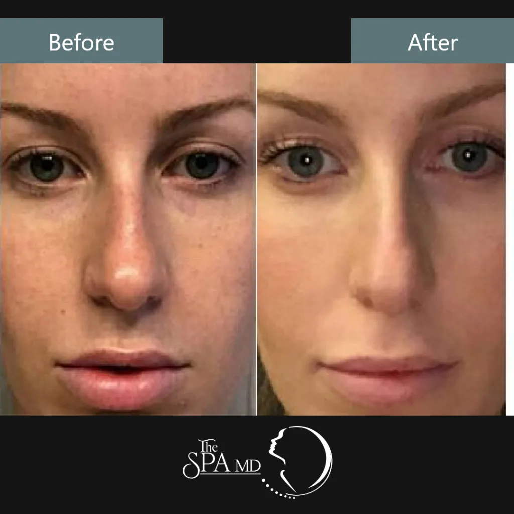 Advanced Perfect 10 Peel Treatment Before and After Images | The Spa MD In Rochester Hills, MI