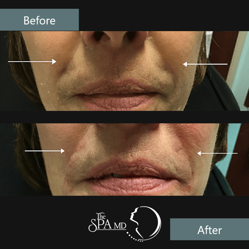 Nasolabial Fold Filler Before and After Images | The Spa MD In Rochester Hills, MI