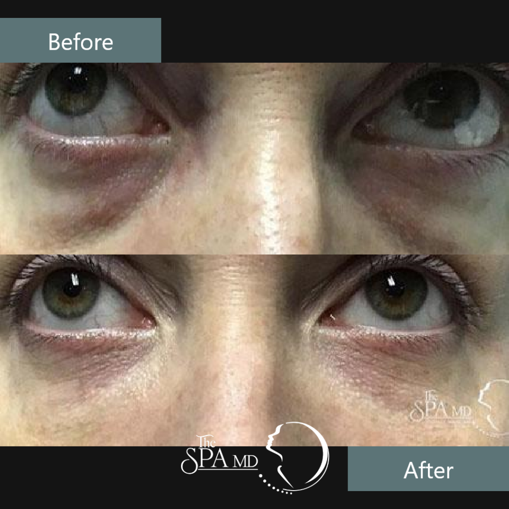 Under Eye Filler Before and After Images | The Spa MD In Rochester Hills, MI