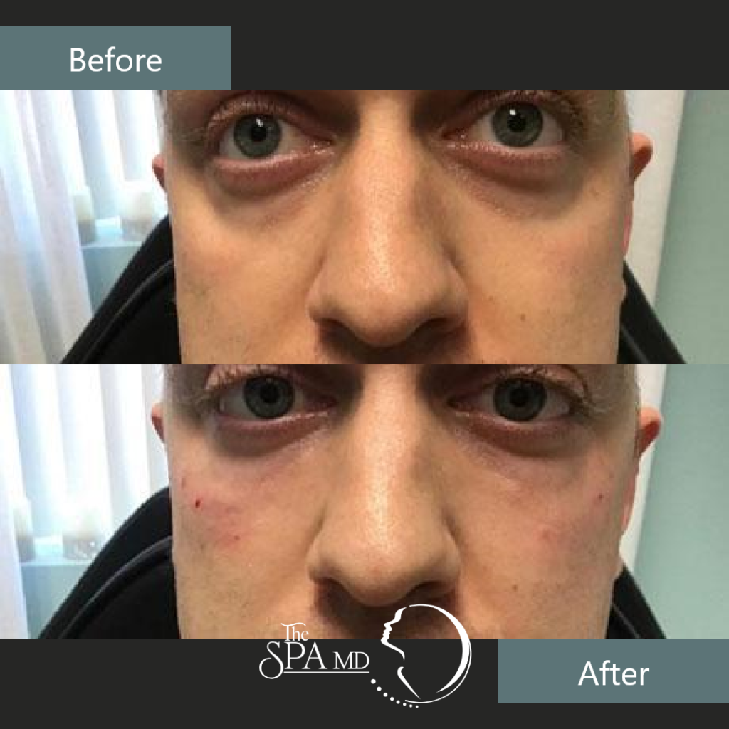 Under Eye Filler Before and After Images | The Spa MD In Rochester Hills, MI