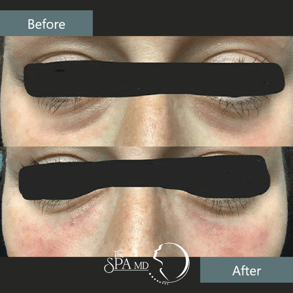 Under Eye Filler Before and After Images | The Spa MD In Rochester Hills, MI