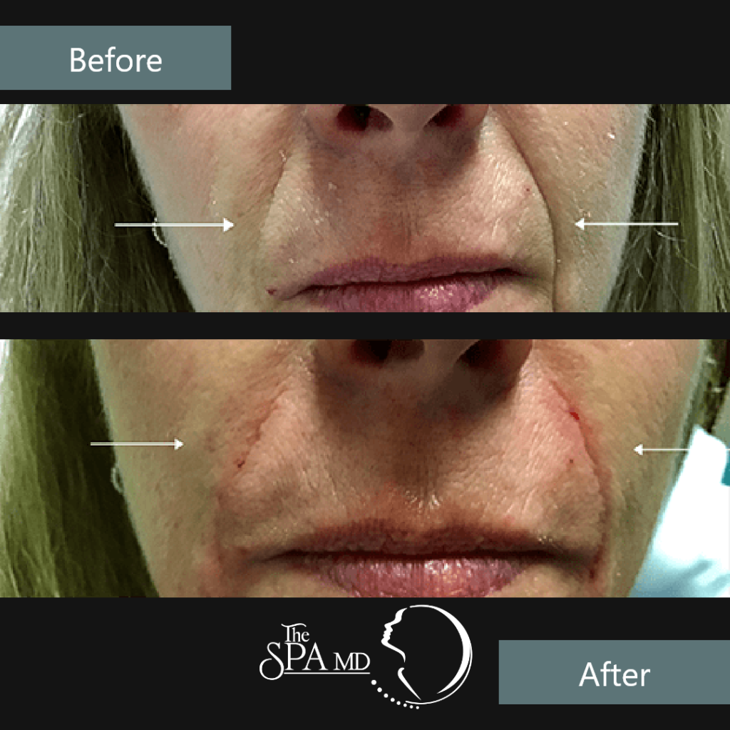 Nasolabial Fold Filler Before and After Images | The Spa MD In Rochester Hills, MI