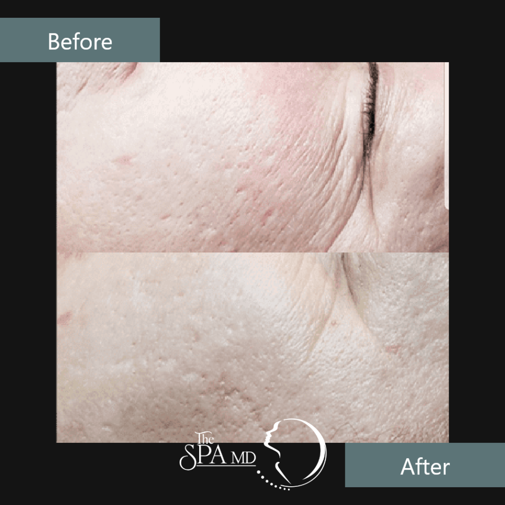 Laser Skin Tightening Before and After Images | The Spa MD In Rochester Hills, MI