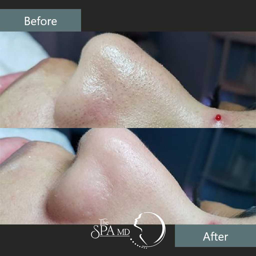 Facial Before and After Images | The Spa MD In Rochester Hills, MI