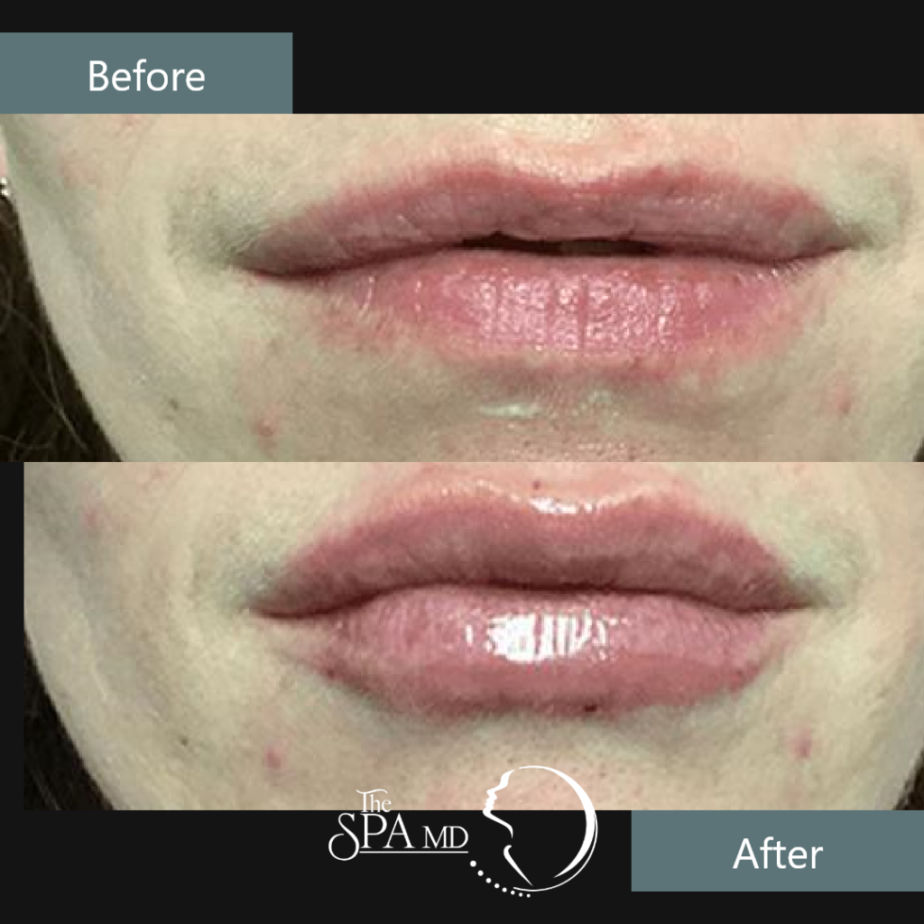 Lips Treatment Before and After Images | The Spa MD In Rochester Hills, MI