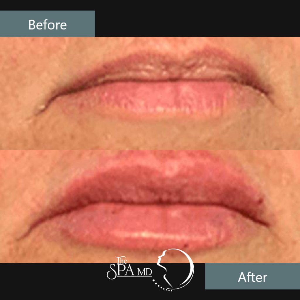 Lips Treatment Before and After Images | The Spa MD In Rochester Hills, MI