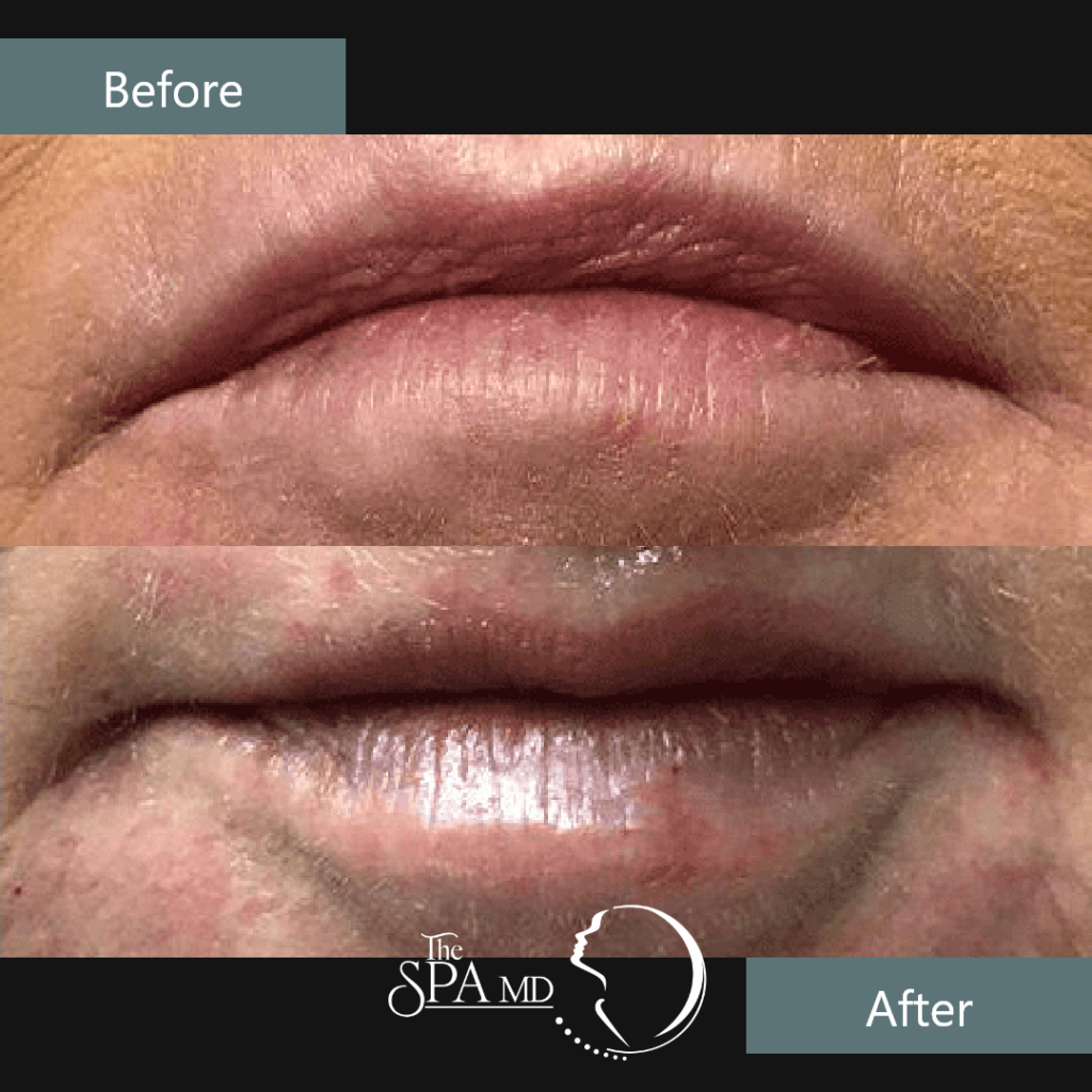 Lips Treatment Before and After Images | The Spa MD In Rochester Hills, MI