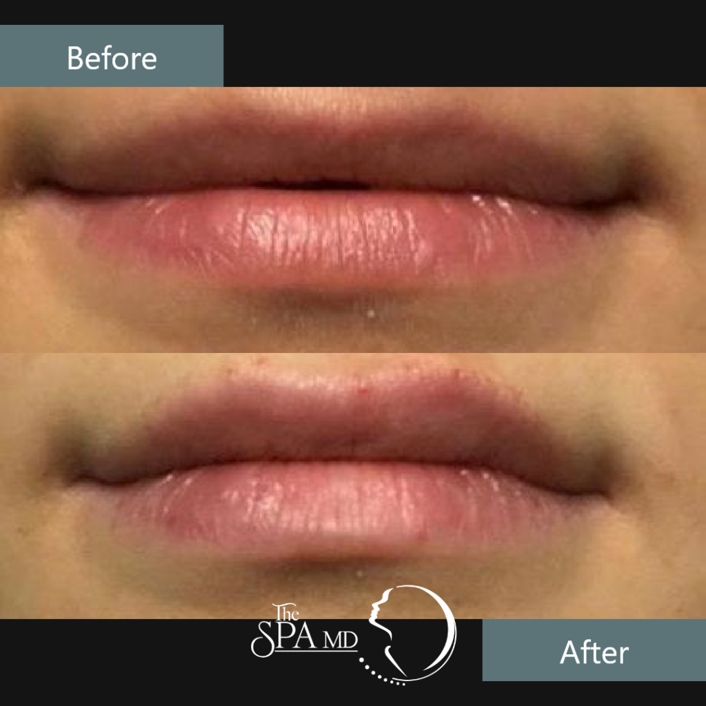 Lips Treatment Before and After Images | The Spa MD In Rochester Hills, MI