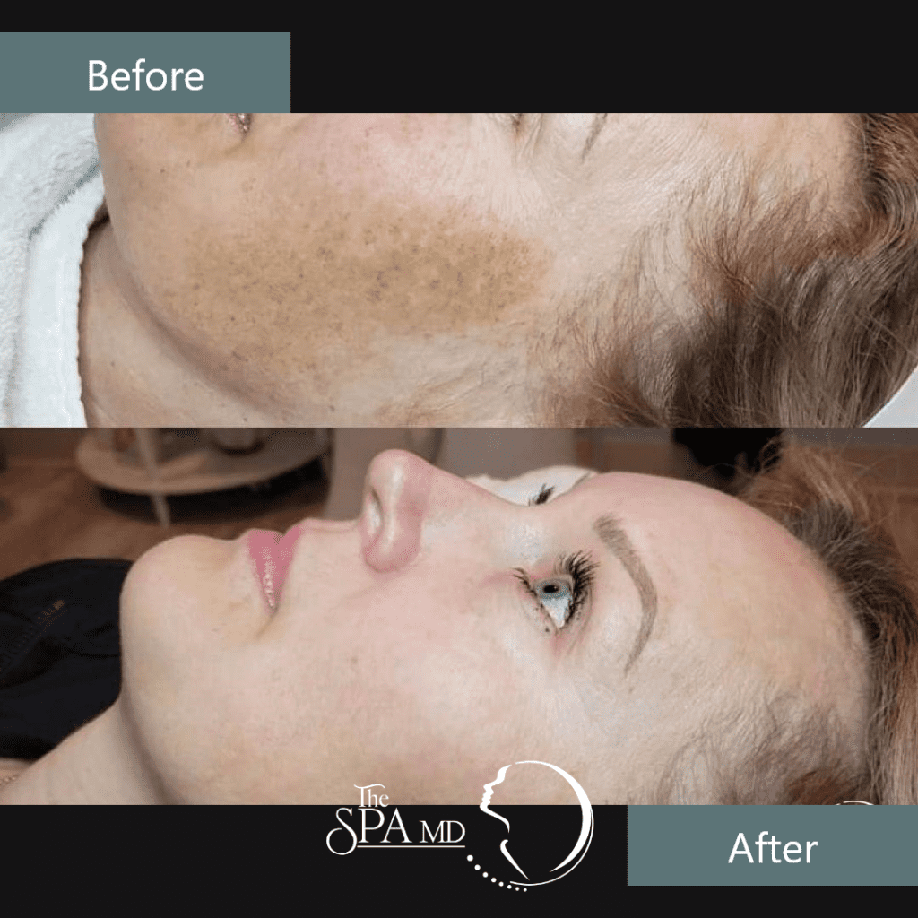 Skin Treatment Before and After Images | The Spa MD In Rochester Hills, MI