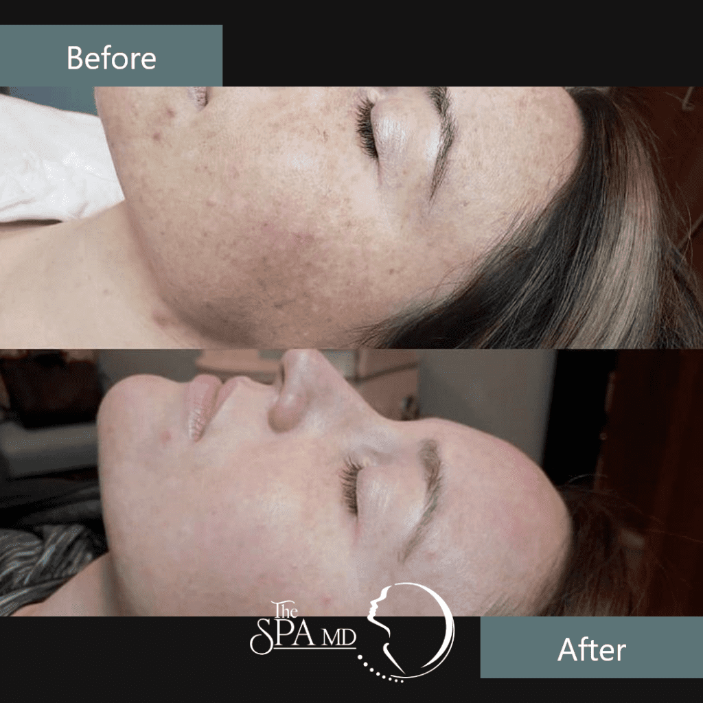 Skin Treatment Before and After Images | The Spa MD In Rochester Hills, MI