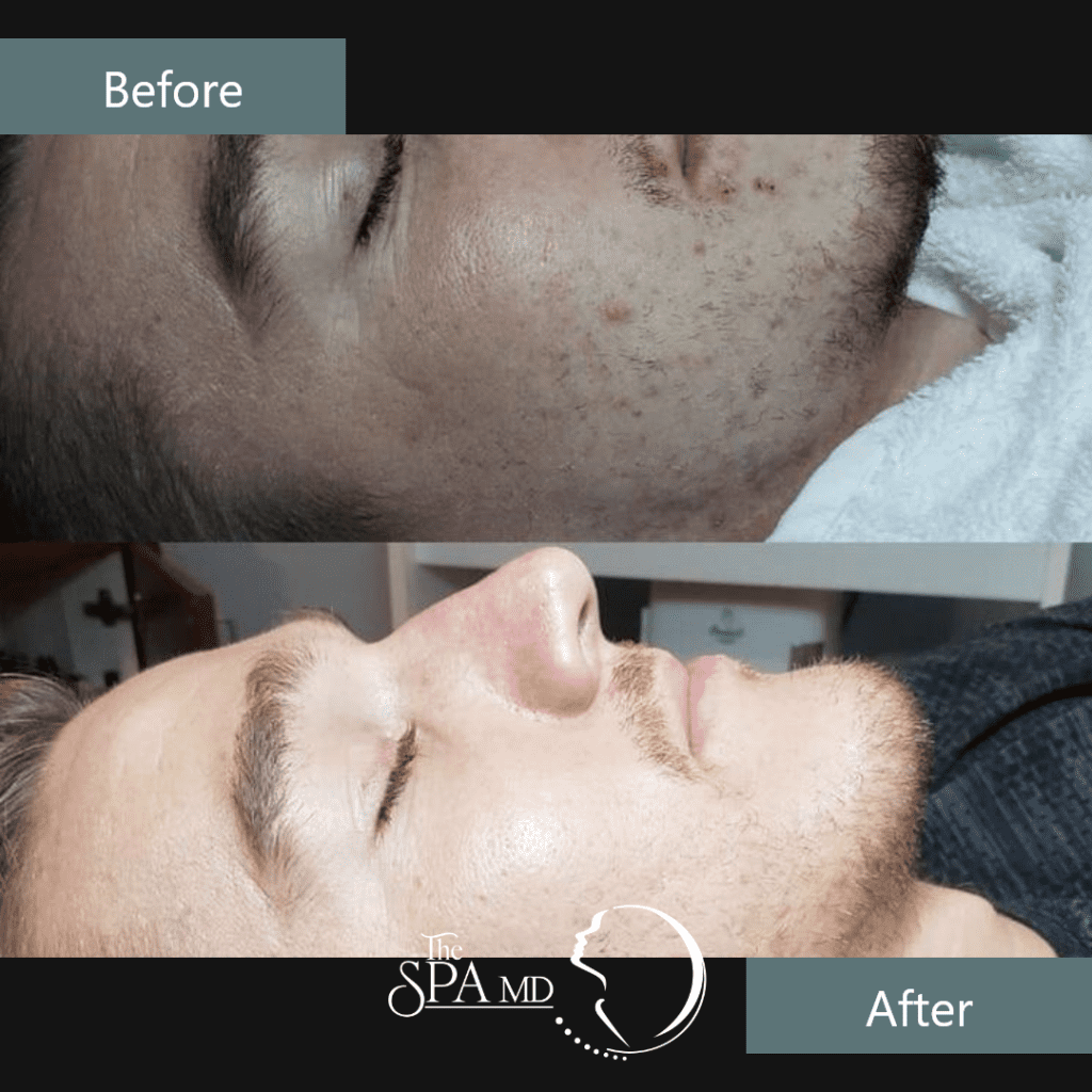 Skin Treatment Before and After Images | The Spa MD In Rochester Hills, MI