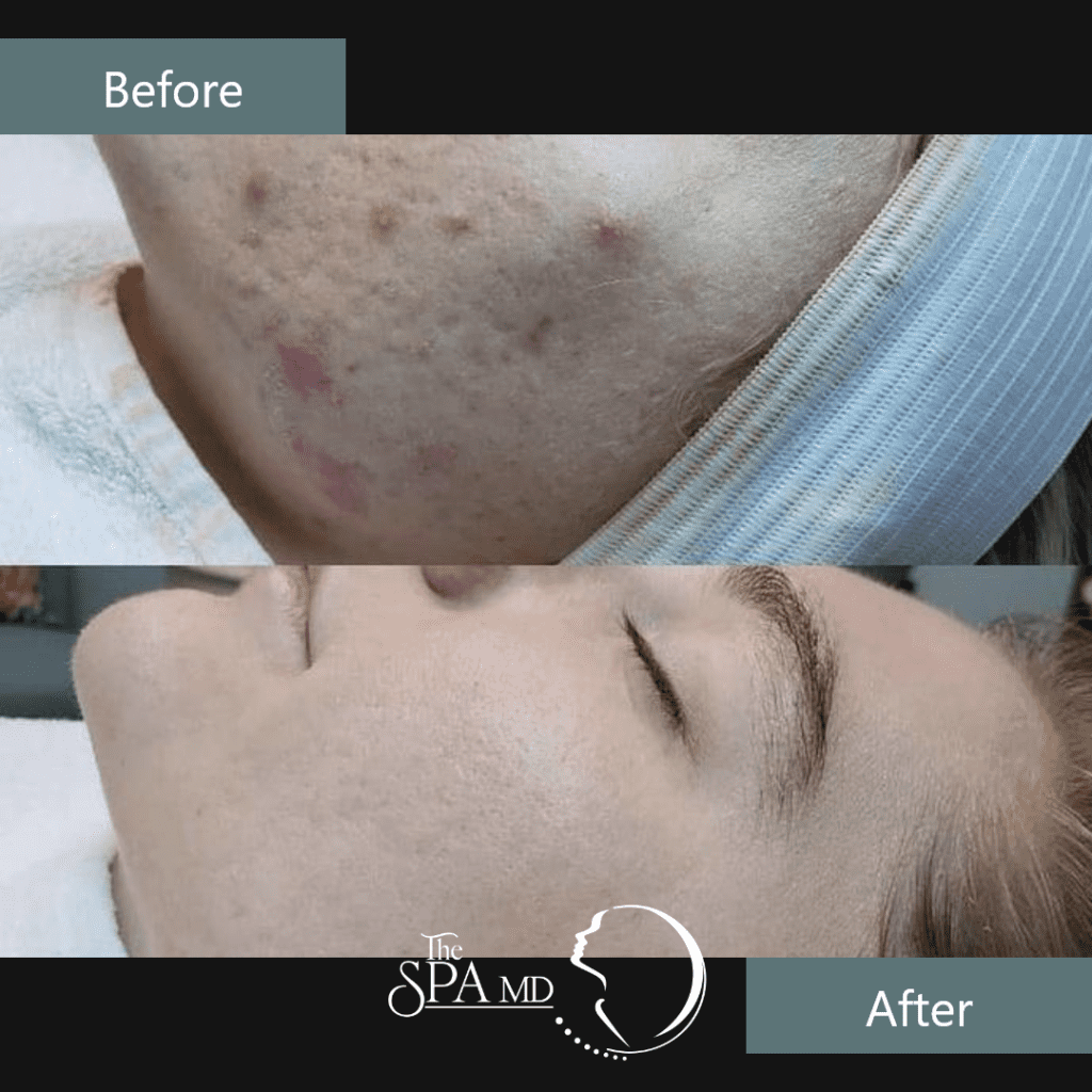 Skin Treatment Before and After Images | The Spa MD In Rochester Hills, MI