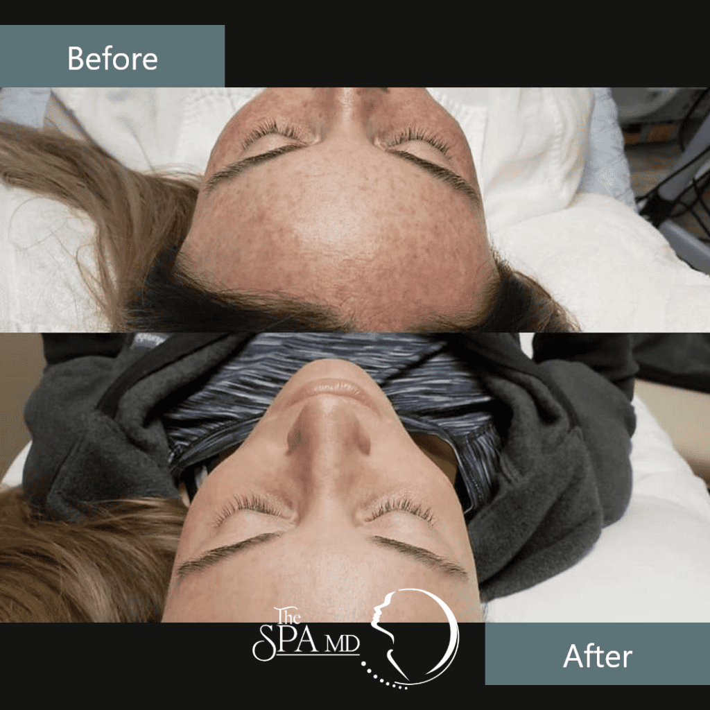 Skin Treatment Before and After Images | The Spa MD In Rochester Hills, MI