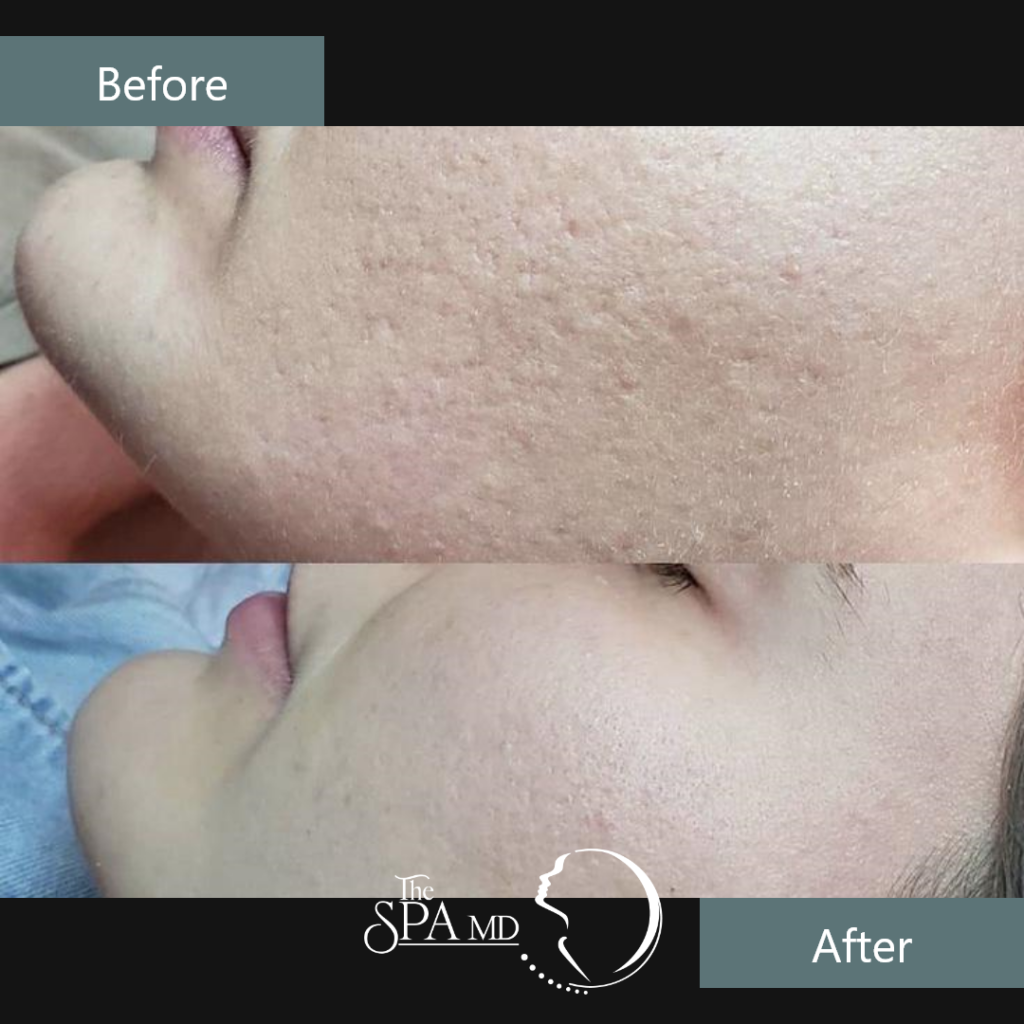 Skin Treatment Before and After Images | The Spa MD In Rochester Hills, MI