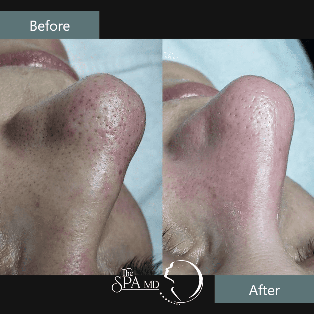 Skin Treatment Before and After Images | The Spa MD In Rochester Hills, MI