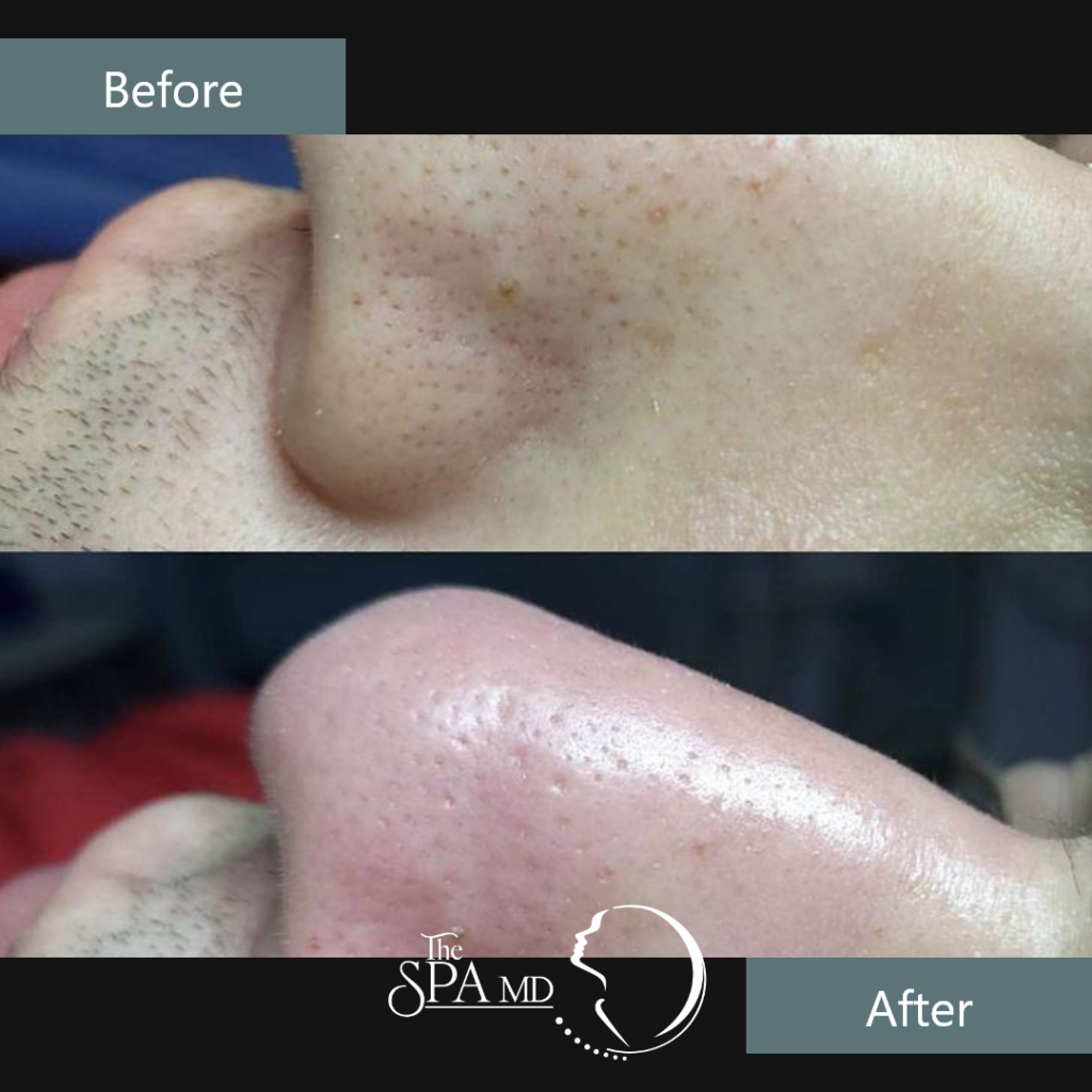 Skin Treatment Before and After Images | The Spa MD In Rochester Hills, MI