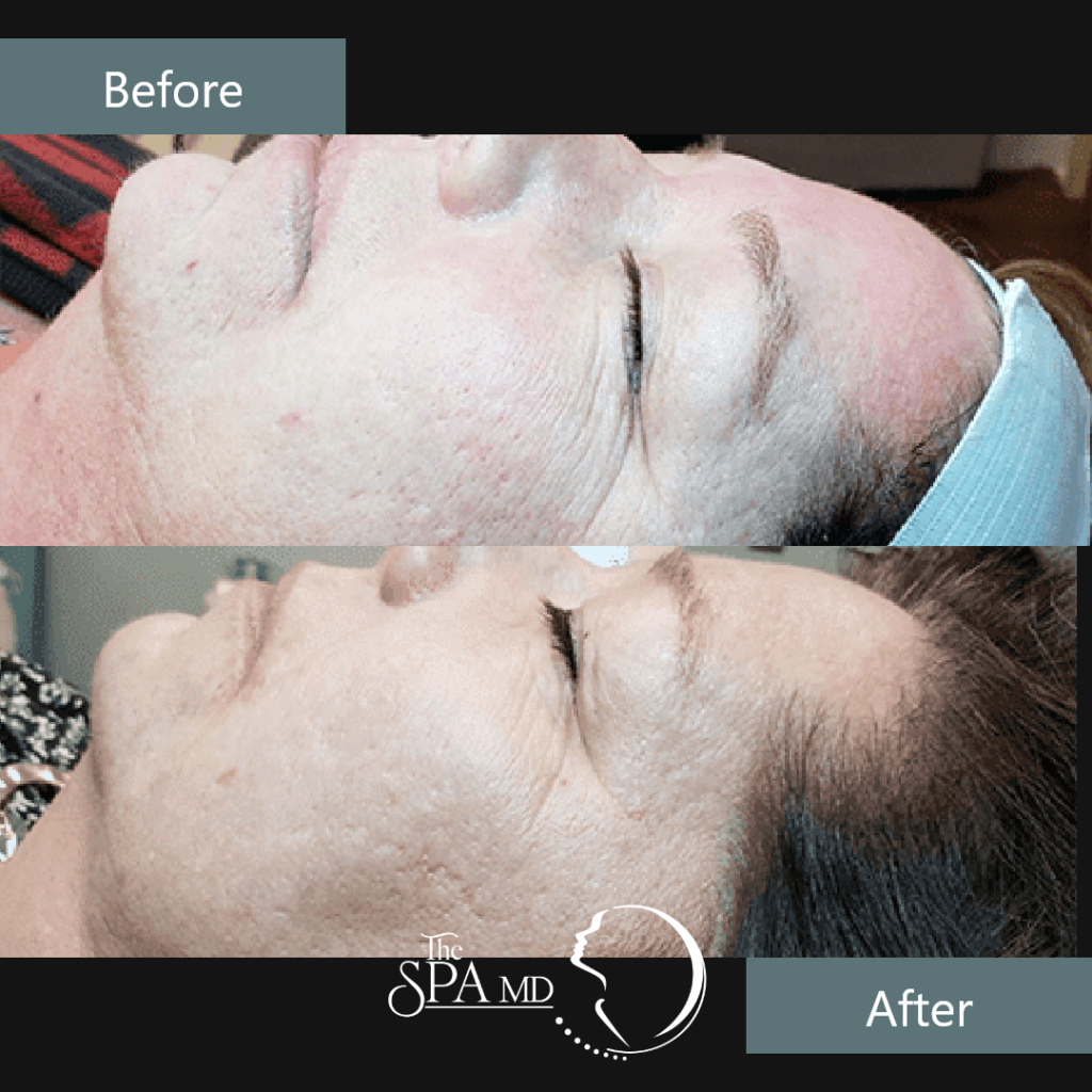 Laser Skin Tightening Before and After Images | The Spa MD In Rochester Hills, MI