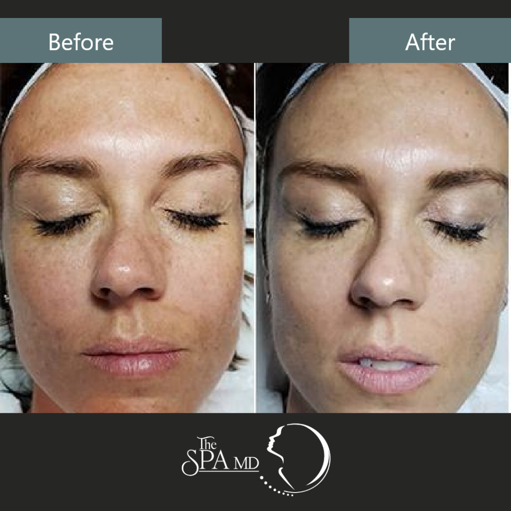 Advanced Perfect 10 Peel Treatment Before and After Images | The Spa MD In Rochester Hills, MI