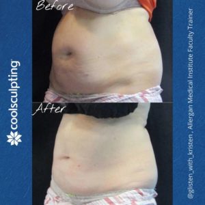 Coolsculpting Before and After Photos | The Spa MD In Rochester Hills, MI
