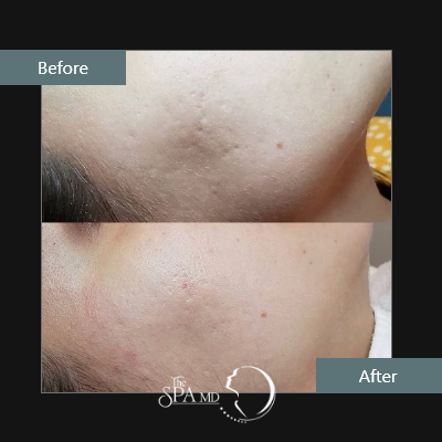Microneedling Before and After Images | The Spa MD In Rochester Hills, MI