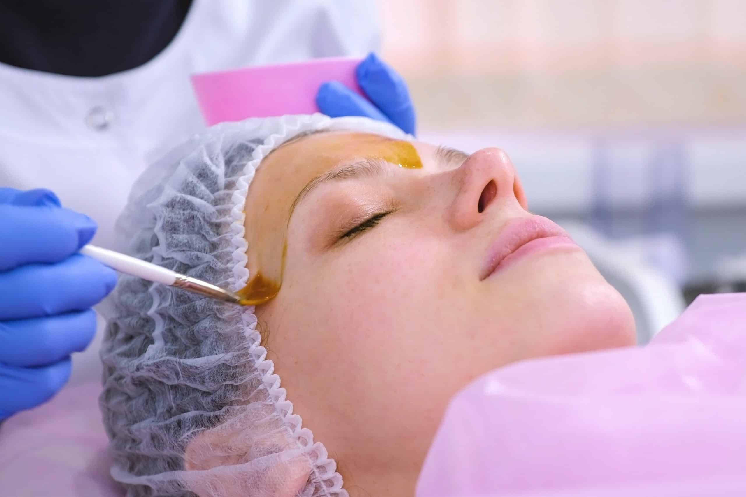 What are the benefits of a chemical peel