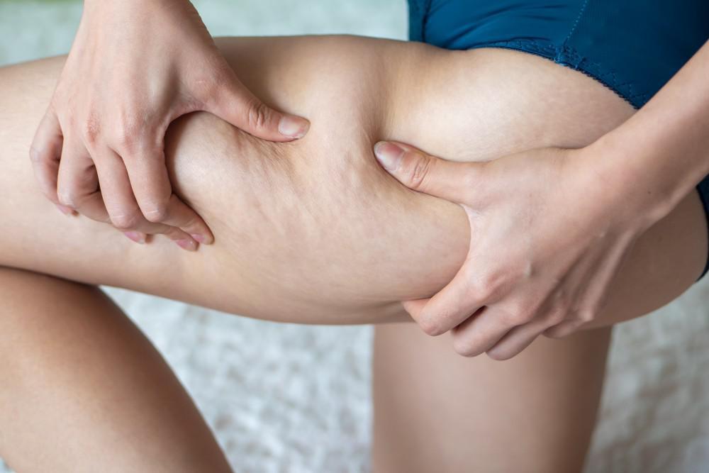 Bothered by Your Cellulite Consider V-Form | The Spa MD In Rochester Hills, MI