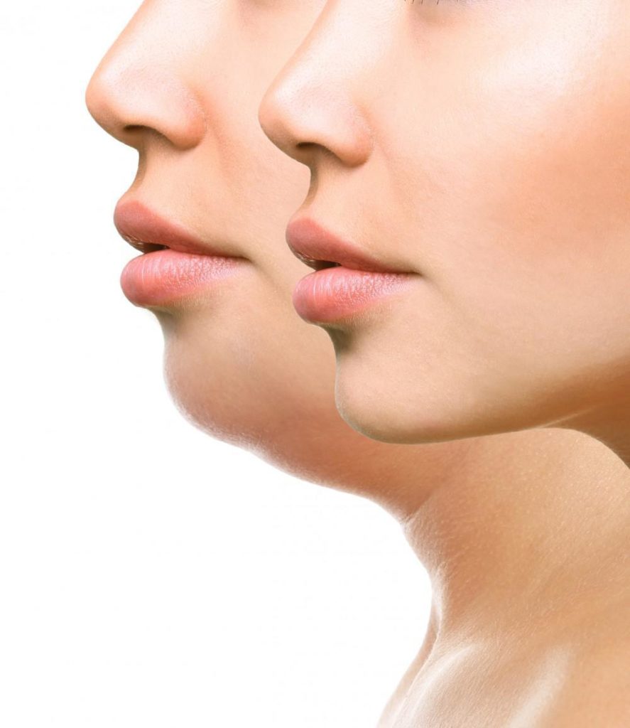Bothered by Your Double Chin Kybella Can Help | The Spa MD In Rochester Hills, MI