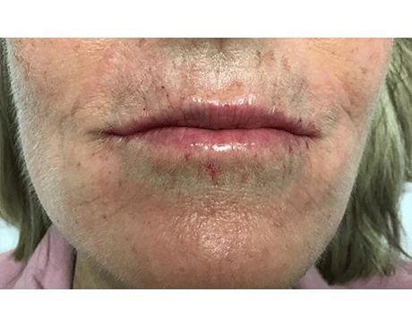 After Pucker Line Treatment Photo | The Spa MD In Rochester Hills, MI