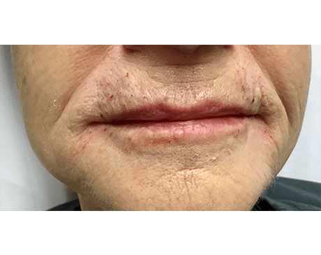 After Pucker Line Treatment Photo | The Spa MD In Rochester Hills, MI