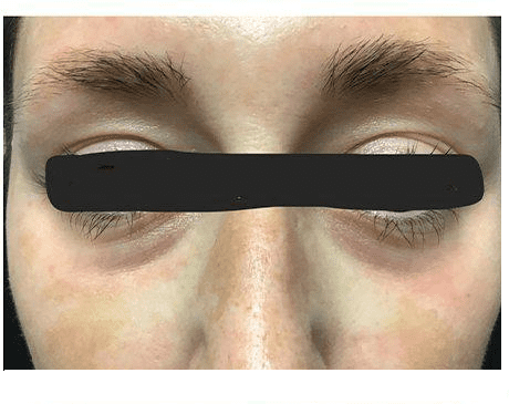 Before Under Eye Filler Treatment Photo | The Spa MD In Rochester Hills, MI