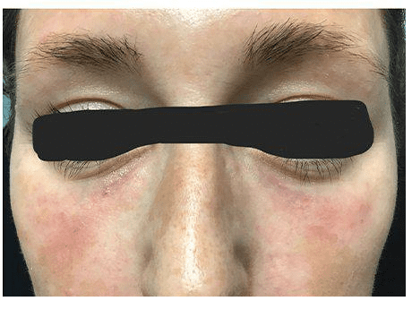 After Under Eye Filler Treatment Photo | The Spa MD In Rochester Hills, MI