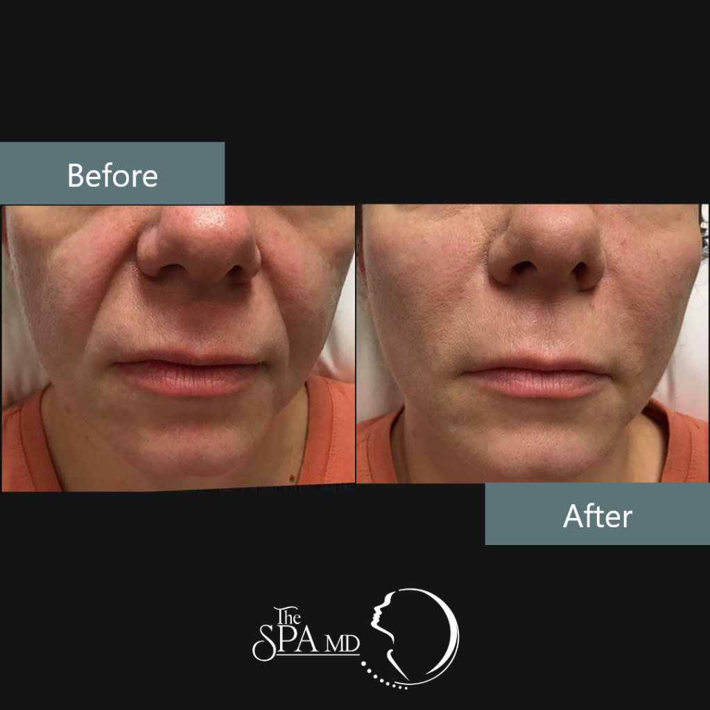 Nasolabial Fold Filler Before and After Images | The Spa MD In Rochester Hills, MI
