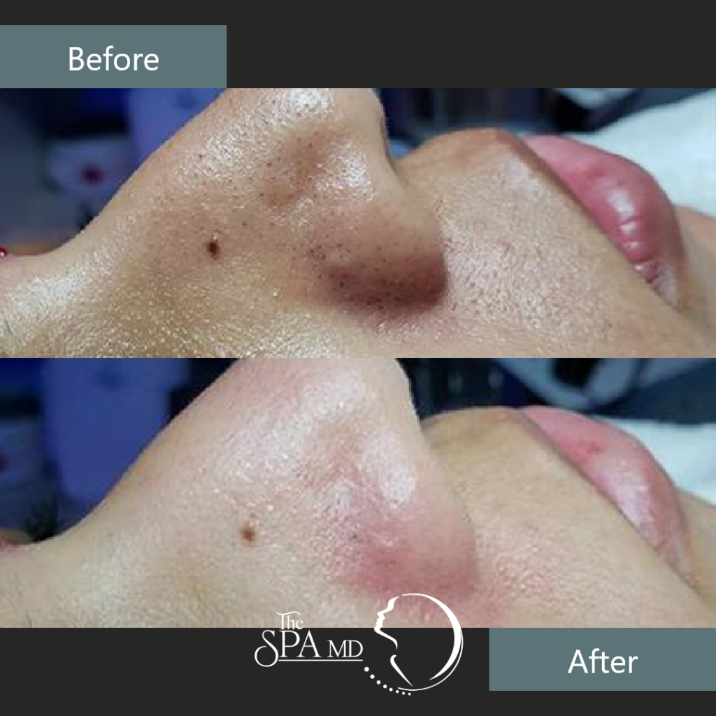 Facial Before and After Images | The Spa MD In Rochester Hills, MI