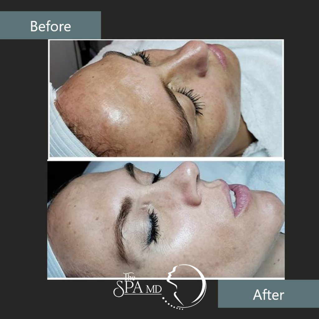Advanced Perfect 10 Peel Treatment Before and After Images | The Spa MD In Rochester Hills, MI