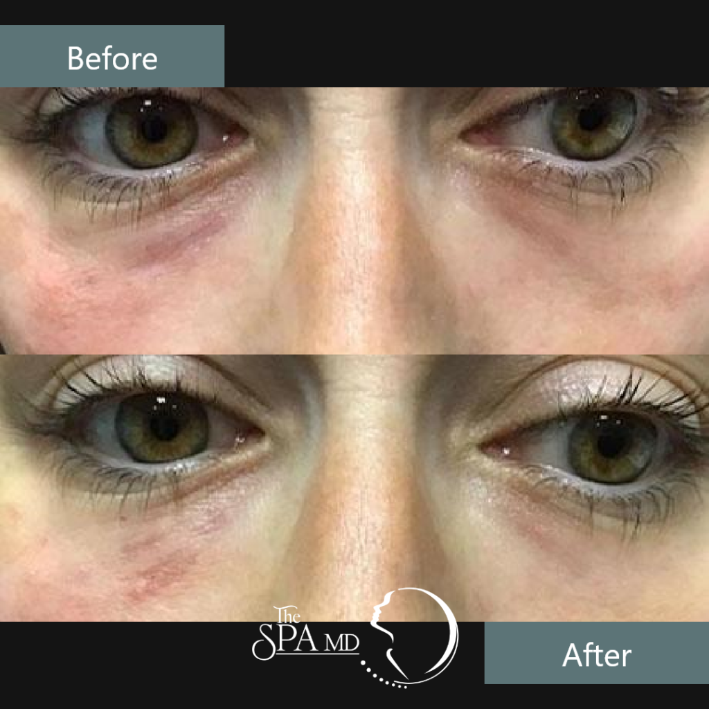 Under Eye Filler Before and After Images | The Spa MD In Rochester Hills, MI