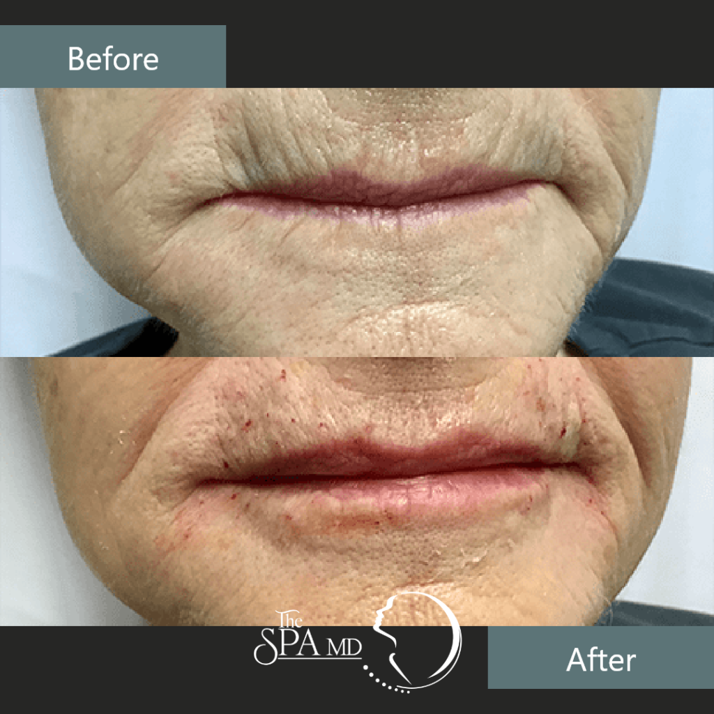 Pucker Line Treatment Before and After Images | The Spa MD In Rochester Hills, MI