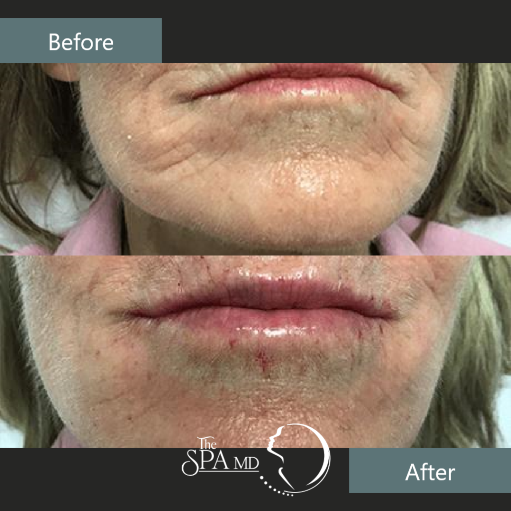 Pucker Line Treatment Before and After Images | The Spa MD In Rochester Hills, MI