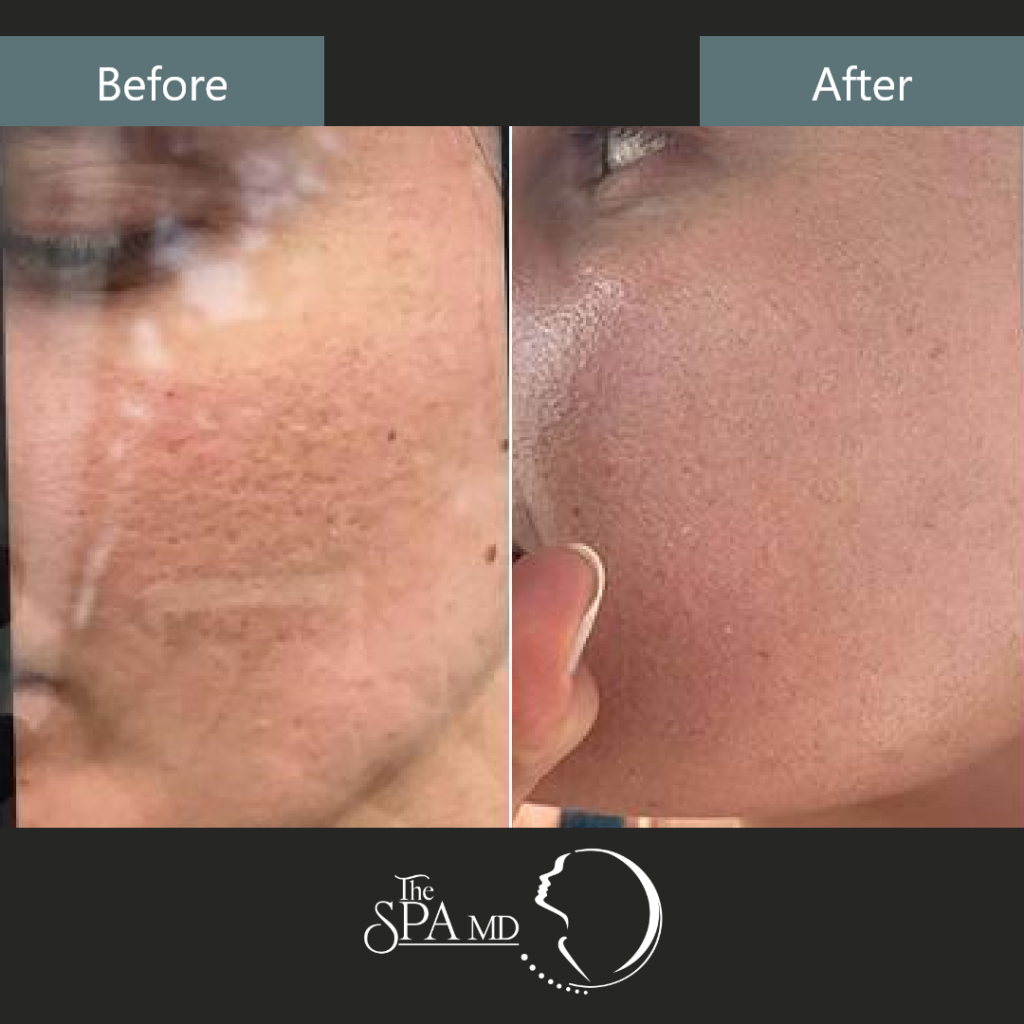 PixelRF Treatment Before and After Images | The Spa MD In Rochester Hills, MI