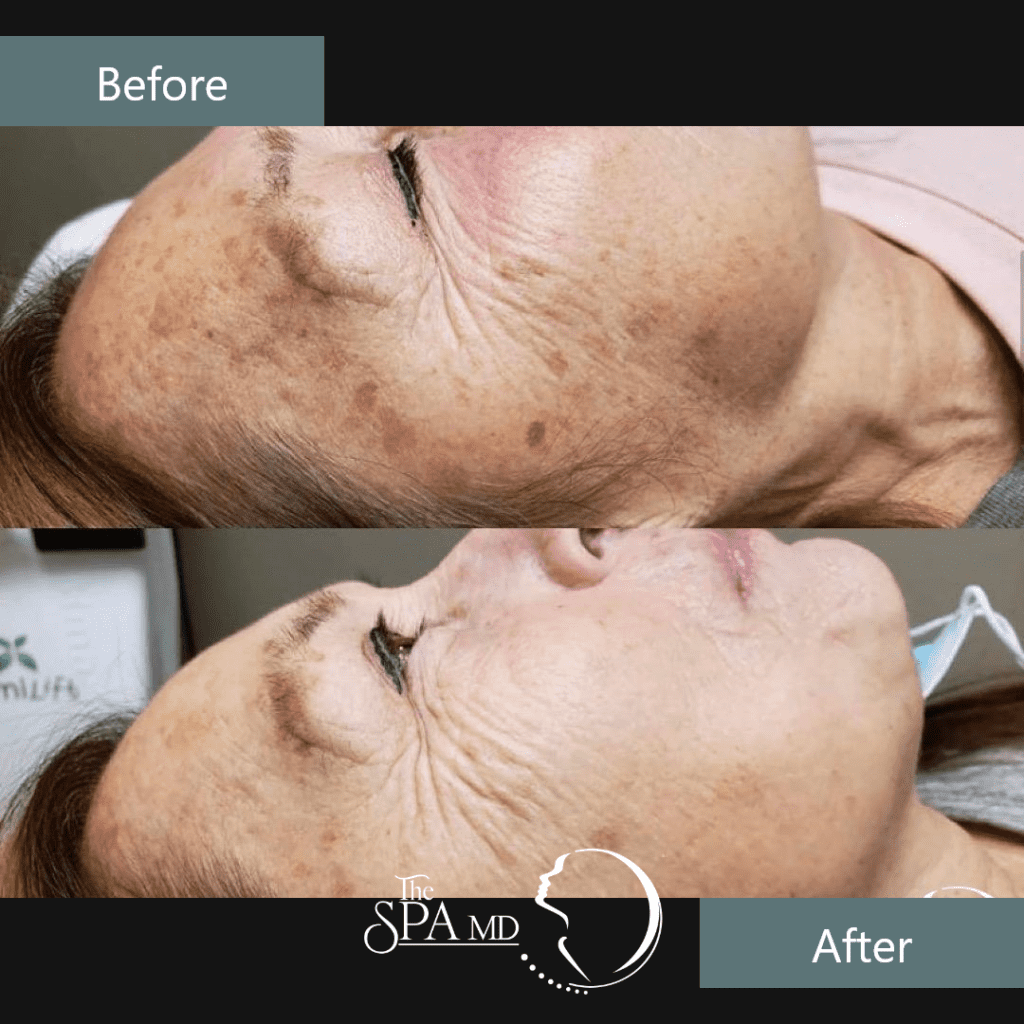 Skin Treatment Before and After Images | The Spa MD In Rochester Hills, MI