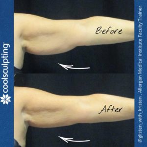 Coolsculpting Before and After Photos | The Spa MD In Rochester Hills, MI