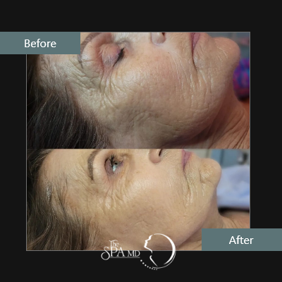 Laser Skin Tightening Before and After Image | The Spa MD In Rochester Hills, MI