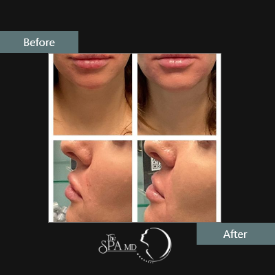 Lips Treatment Before and After Images | The Spa MD In Rochester Hills, MI