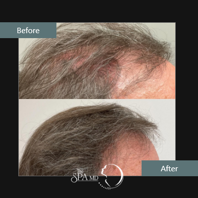 Natural Growth Factors Hair Restoration Before and After Images | The Spa MD In Rochester Hills, MI